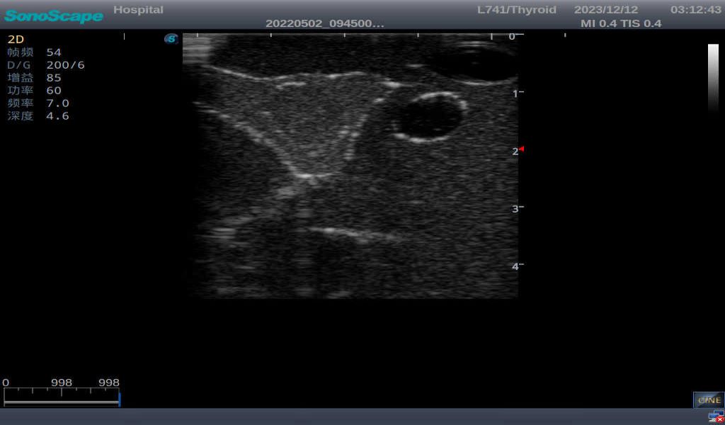 Thyroid Ultrasound Training Model